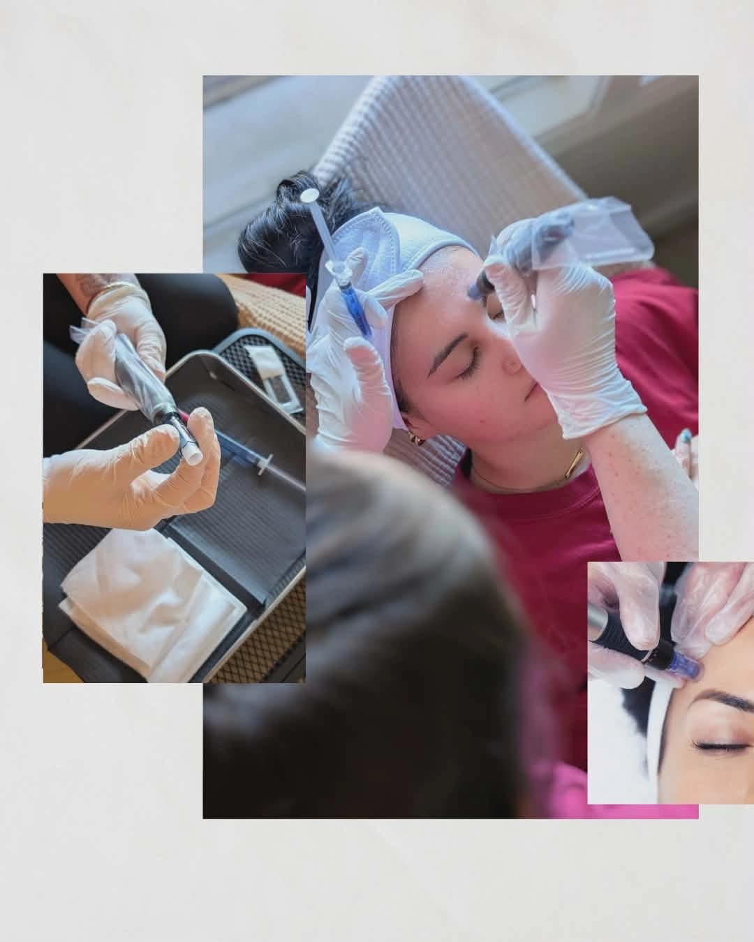 Microneedling treatment